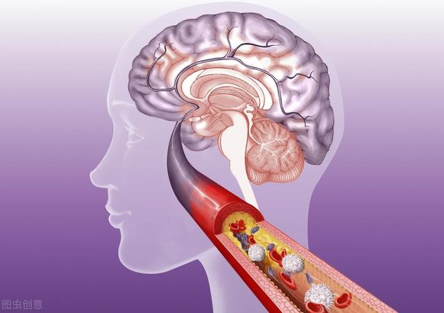 脑中风已成疾病致死首因,睡前别做4件事,减少脑卒中夜间发作率